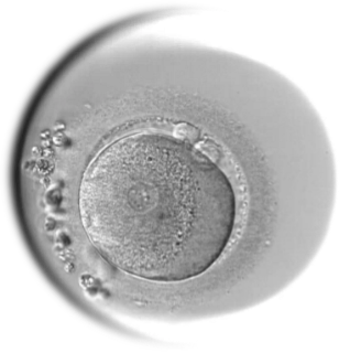 An inseminated egg classified as 1PN (monopronuclear).