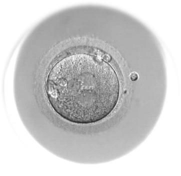 An inseminated egg classified as 3PN (three pronuclei)