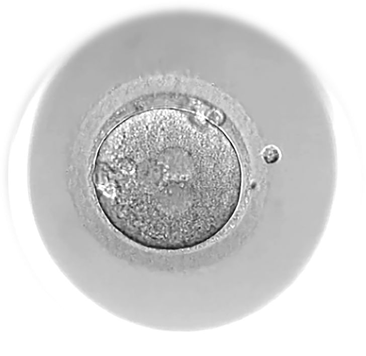 An inseminated egg classified as 3PN (three pronuclei)